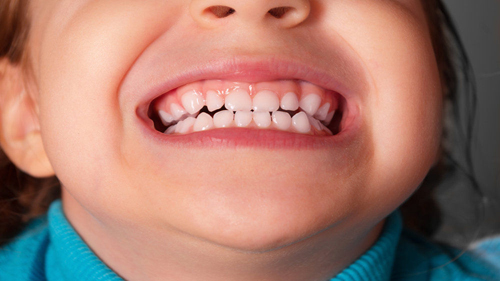 Скрежет зубами у детей с синдромом дауна